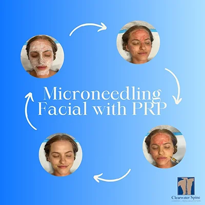 Stem Cell Therapy Clearwater FL Microneedling Facial Graphic